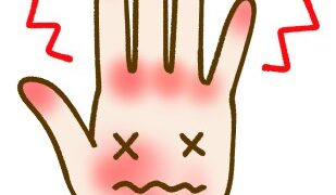 しもやけ　予防　訪問診療　　